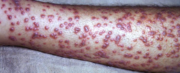 an image of smallpox blisters